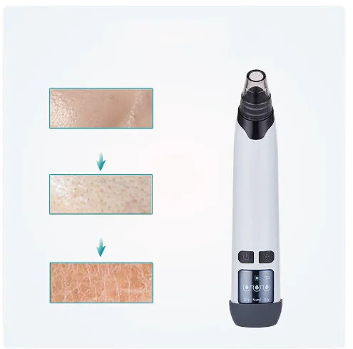 Blackhead Remover Vacuum